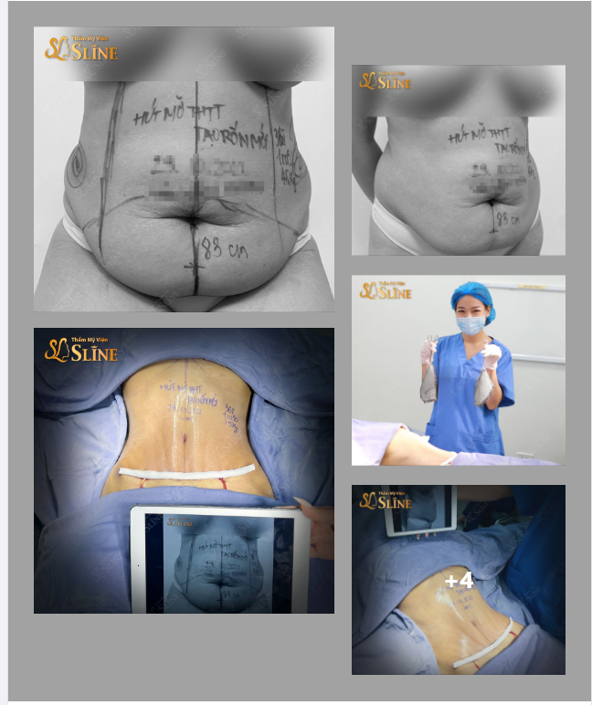 Quá nhiều mỡ và da chùng  được loại bỏ sau 180 phút.