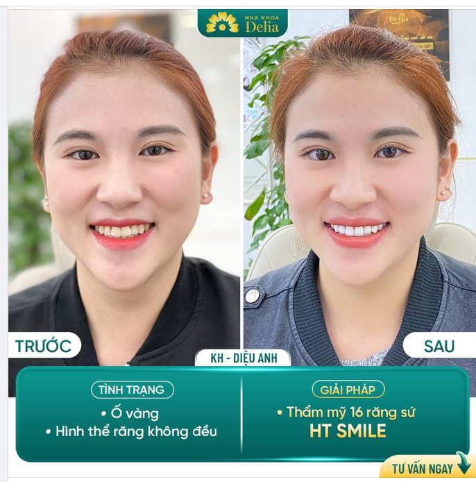 Răng khấp khểnh, ố vàng - Thẩm mỹ răng sứ Bio Invio 3I khắc phục sau 48H