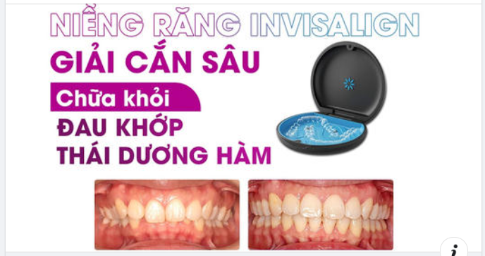 REVIEW NIỀNG RĂNG GIẢI CẮN SÂU, ĐAU KHỚP HÀM