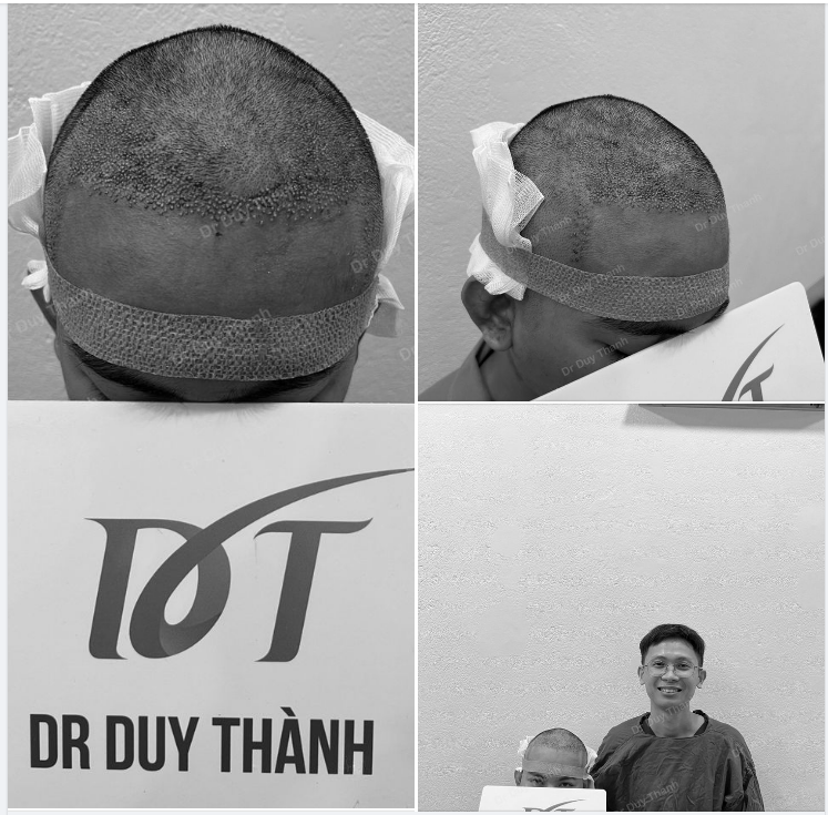 KẾT QUẢ CẤY 1700 NANG TÓC NGÀY HÔM QUA - BOY NGHỆ AN 29 TUỔI