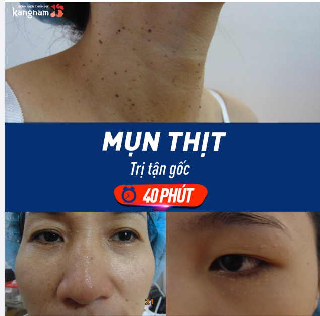 Mụn thịt ở cổ, má, mắt,…khiến da sần sùi