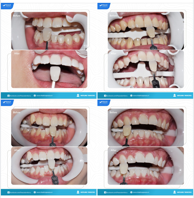 SỞ HỮU HÀM RĂNG TRẮNG SÁNG - AN TOÀN - NHANH CHÓNG VỚI TẨY TRẮNG RĂNG CÔNG NGHỆ ĐÈN CHIẾU HIỆN ĐẠI