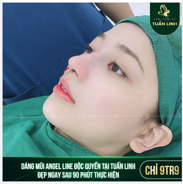 Sở hữu ngay dáng mũi Angel Line độc quyền tại Tuấn linh chỉ với 9tr9