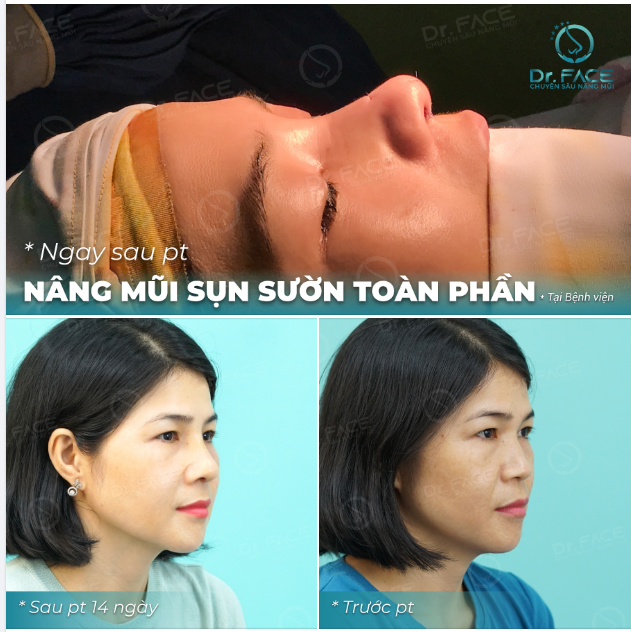 Sụn sườn biến chiếc mũi “GỒ GHỀ” thành “CỰC PHẨM”
