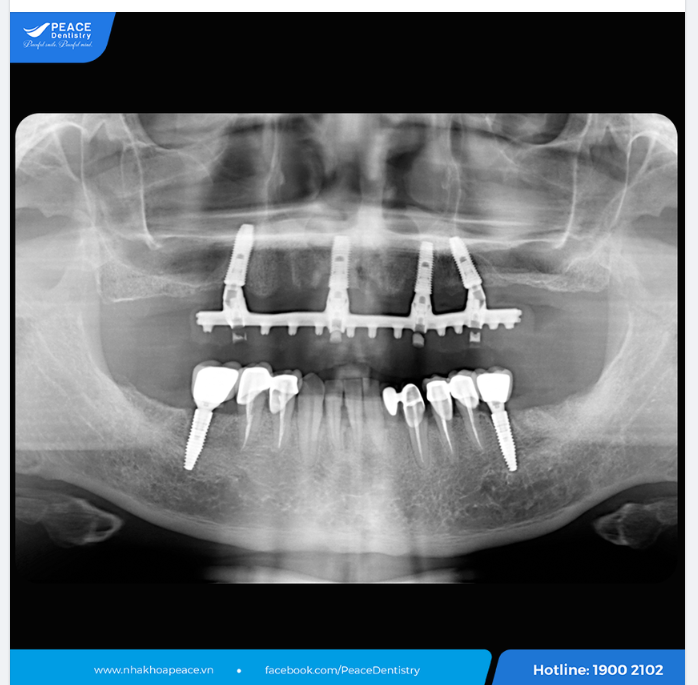Tái khám Implant sau 4 năm. Mọi vết thương đã được thời gian chữa lành, hiện tại đã là hàm răng chắc khoẻ như thời niên thiếu. Và tương lai lâu dài vẫn sẽ còn ổn định như thế!