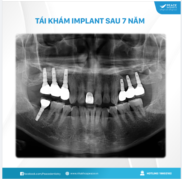 TÁI KHÁM IMPLANT SAU 7 NĂM