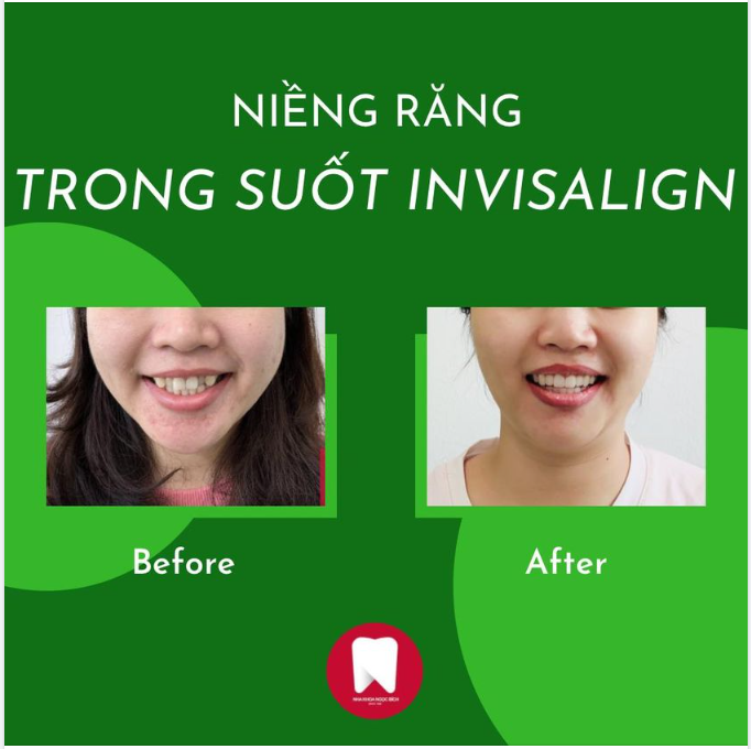 TẠM BIỆT HÀM RĂNG CHEN CHÚC SAI KHỚP CẮN CHỈ SAU 6 THÁNG