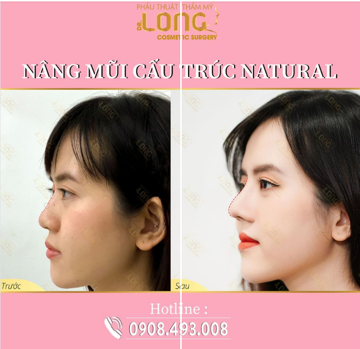 Tạo hình dáng mũi mới bằng kỹ thuật kết hợp giữa sóng nhân tạo và sụn tự thân.