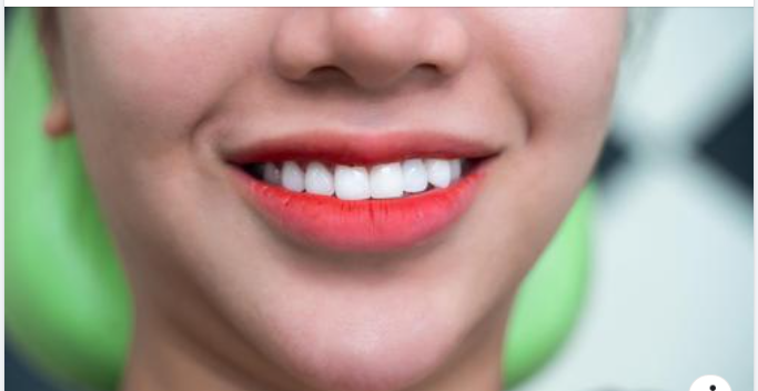 THẨM MỸ RĂNG SỨ CHO HÀM RĂNG KHẤP KHỂNH