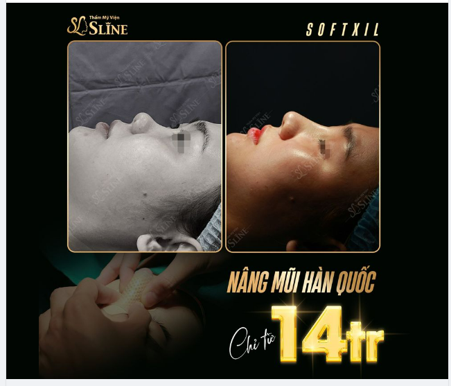 Tháng vàng cho nàng làm đẹp 10 suất duy nhất Nâng Mũi Hàn Quốc  chỉ còn 14tr.