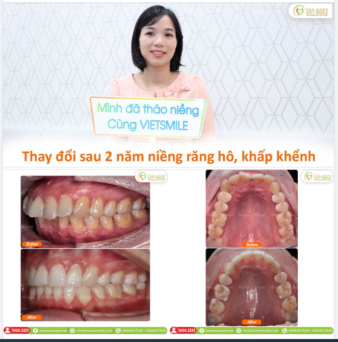 THAY ĐỔI SAU 2 NĂM NIỀNG RĂNG HÔ, KHẤP KHỂNH