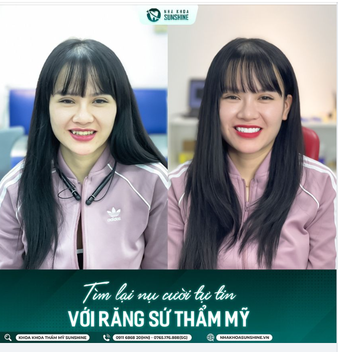 Thế mới thấy, sự kỳ diệu của phương pháp bọc răng sứ mang lại.