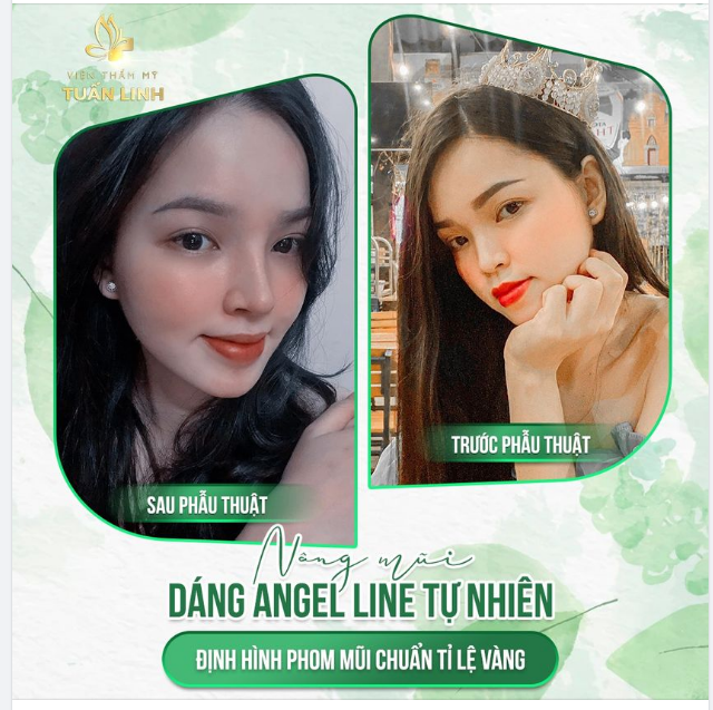 Thích mũi cao nhưng vẫn muốn đẹp tự nhiên Chọn ngay dáng mũi Angel line tại Tuấn Linh nha.