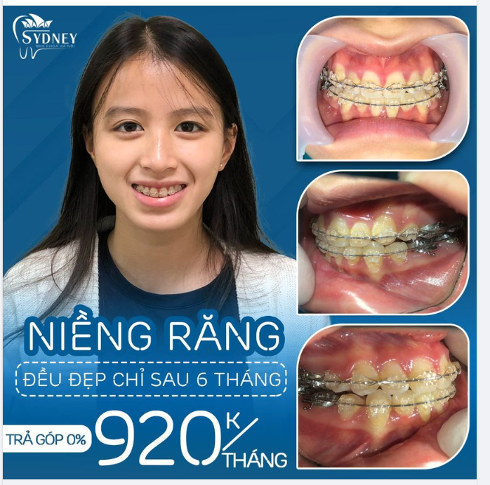 Tìm lại sự tự tin với nụ cười xinh chỉ 920k/tháng
