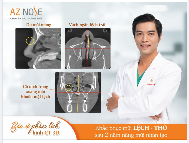 Tình trạng mũi sau 2 năm nâng mũi nhân tạo