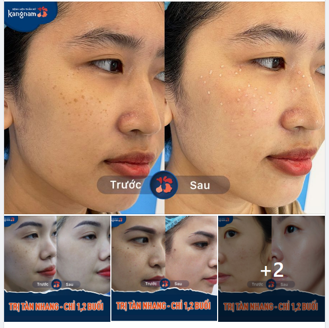 Trăm nghe không bằng một thấy. Cận cảnh những làn da sau điều trị Tàn nhang với Laser Picosure tại Kangnam.