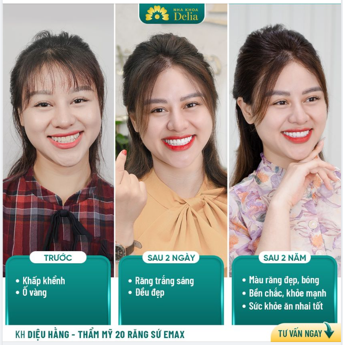 Trọn bộ 20 răng sứ Emax - Bền đẹp dài lâu - Khách hàng Diệu Hằng đã kiểm chứng