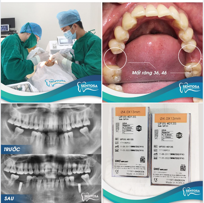 TRỒNG 2 RĂNG IMPLANT MÀ VÔ CÙNG NHẸ NHÀNG NHANH GỌN