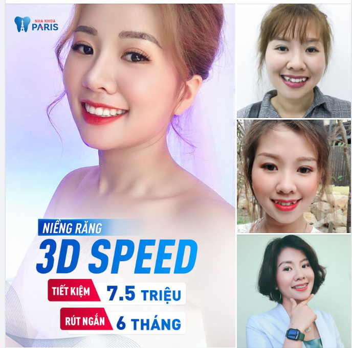 Tưởng PTTM Nhưng Lại Là Niềng Răng