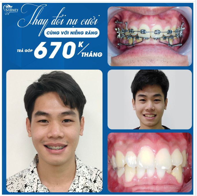 Ưu điểm của mắc cài kim loại