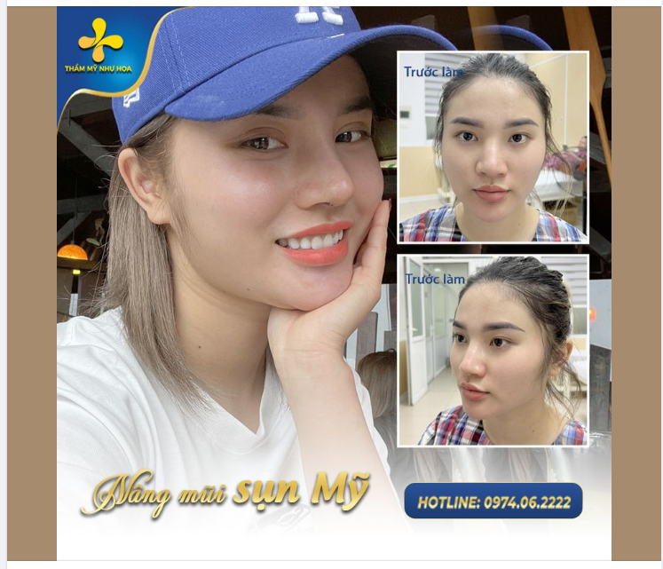 ƯU ĐIỂM CỦA PHƯƠNG PHÁP NÂNG MŨI SỤN MỸ MÀ KHÁCH HÀNG KHÔNG THỂ BỎ QUA