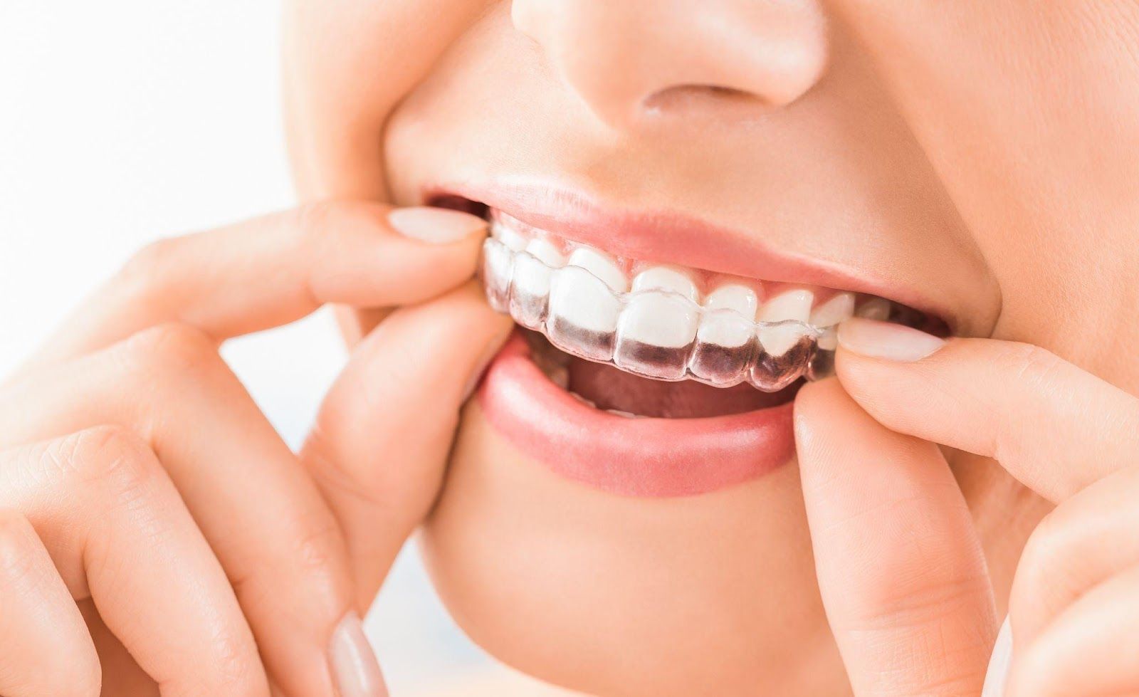 Niềng răng trong suốt giúp bạn thoải mái trong ăn uống và giao tiếp.
