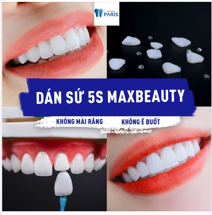 VENEER SỨ TÍCH HỢP CÔNG NGHỆ ĐỊNH VỊ 5S MAXBEAUTY CÓ GÌ ĐẶC BIỆT?