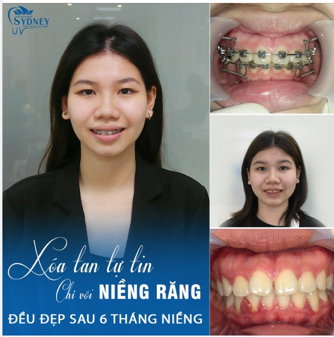 Vì sao niềng răng mắc cài kim loại vẫn được ưa chuộng?