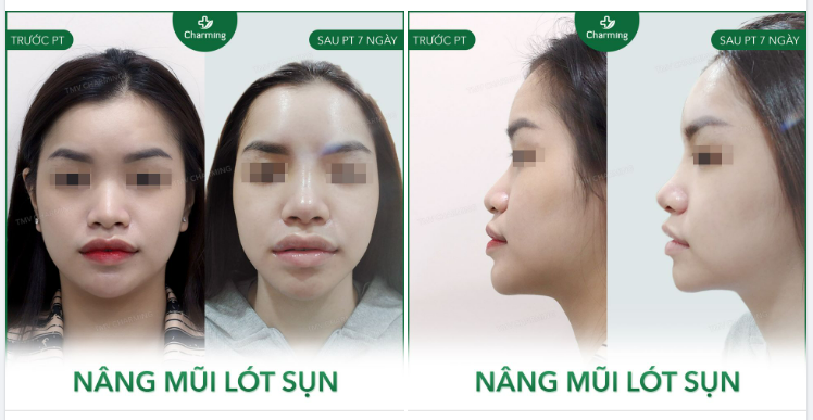 Với một khuôn mặt mà cằm và môi quá đầy đặn thì mũi thấp khiến phần trên như thể thụt hẳn vào trong từ góc nhìn nghiêng.