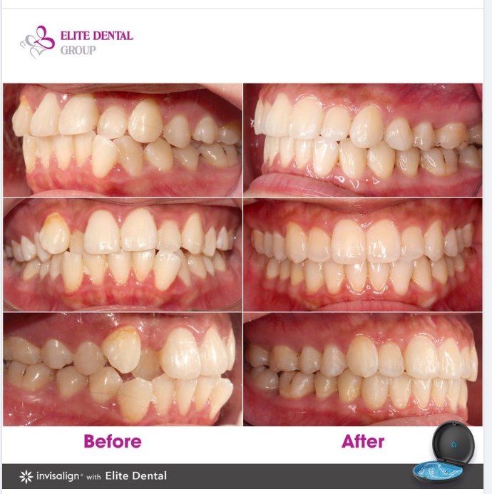 Xếp đều răng khấp khểnh, điều trị các răng cắn chéo, chỉnh lệch đường giữa hiệu quả với niềng răng trong suốt