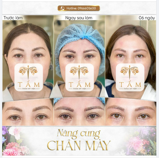 Xoá sổ Da dư, mỡ mắt chỉ 45 phút!