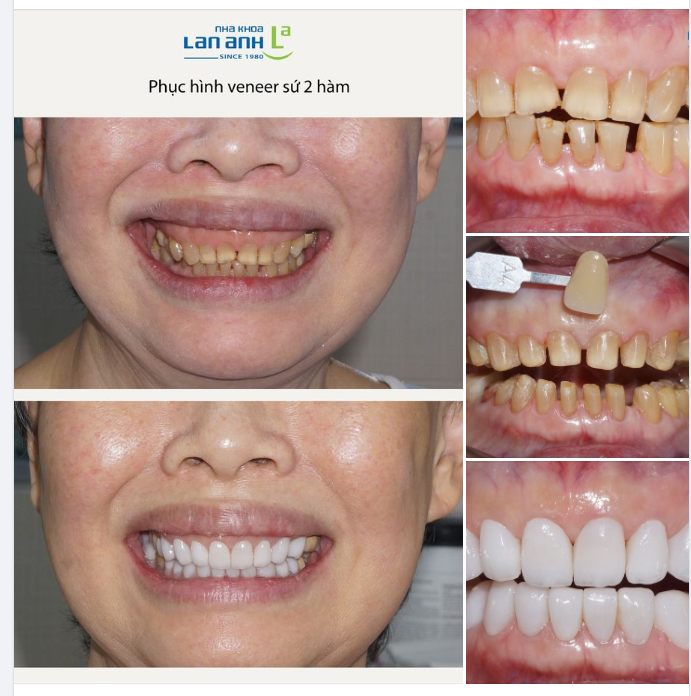 Một case Phục hình Veneer sứ xứng đáng 10 điểm.