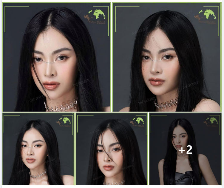 Tạo hình mũi cấu trúc S.LINE tự nhiên cho quý cô có khiếm khuyết da mũi mỏng 