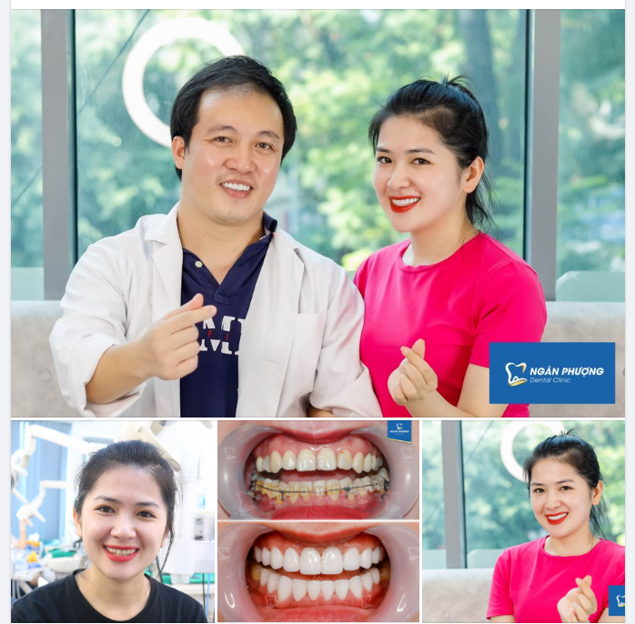 Hành trình răng sứ của chị Thuý Hằng dài hơn thông thường song thành quả lại ưng ý ngoài sức tưởng tượng.