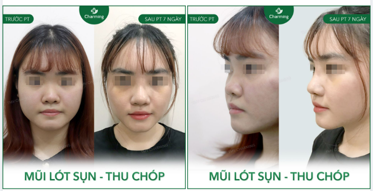 Sóng mũi thấp nhưng chóp to khiến chiếc mũi đánh võng một đường thật cong, thật to trên khuôn mặt.