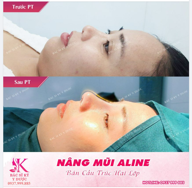 Đây là dáng mũi ALINE thần thánh tạiBác sĩ Kỳ Y Dược