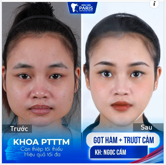 Thành quả sau 3 tuần  gọt hàm  trượt cằm của Ngọc Cẩm