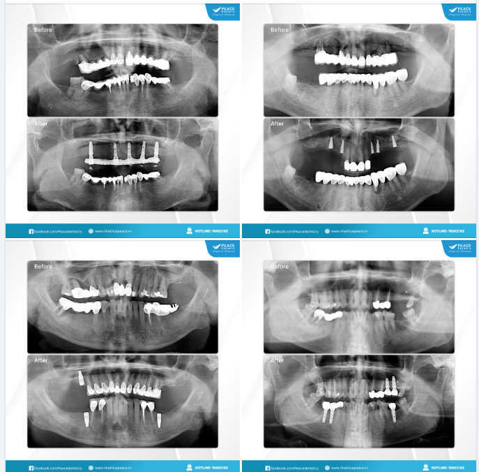 XU HƯỚNG CẤY GHÉP IMPLANT ĐỂ THAY THẾ CHO CÁC CẦU RĂNG SỨ CŨ, CẦU RĂNG SỨ ĐÃ XUỐNG CẤP