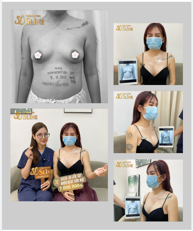 V1 teo lép, không cân đối, khe ngực xa nhau, mô tuyến lỏng lẻo , mất độ đàn hồi