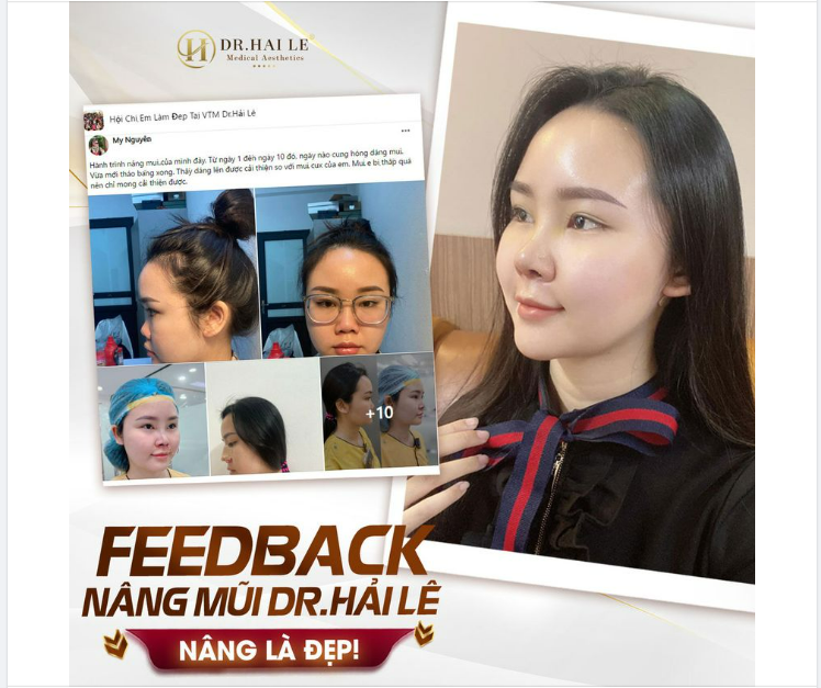Feedback hành trình nâng mũi của bạn KH nhà Dr.Hải Lê tại group làm đẹp Hội Chị Em Làm Đẹp Tại VTM Dr.Hải Lê