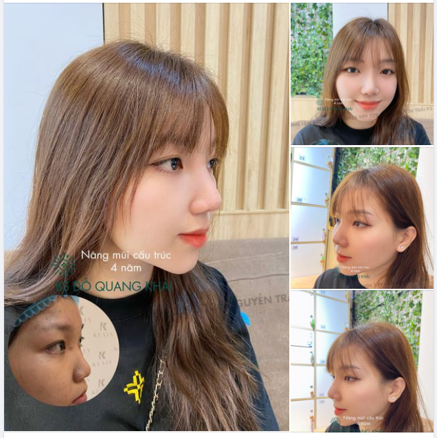 DÁNG MŨI CẤU TRÚC SAU 4 NĂM CÓ CÒN BỀN ĐẸP NHƯ BS TƯ VẤN?