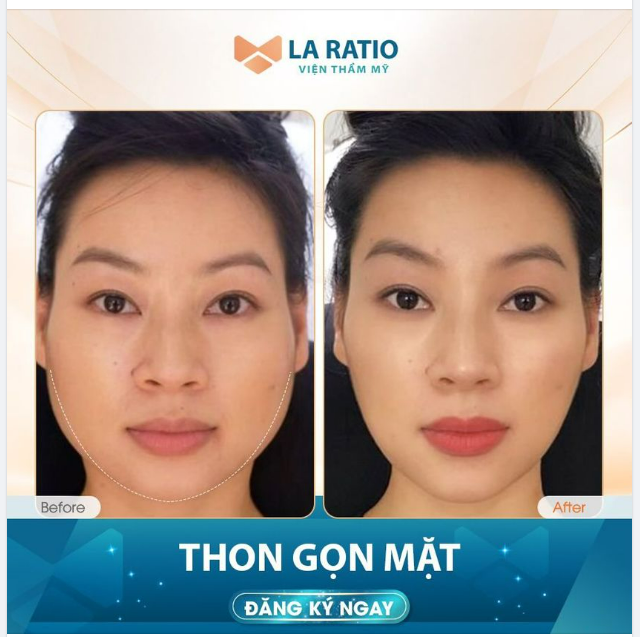 THON GỌN GÓC HÀM SẼ THAY ĐỔI GƯƠNG MẶT RA SAO?