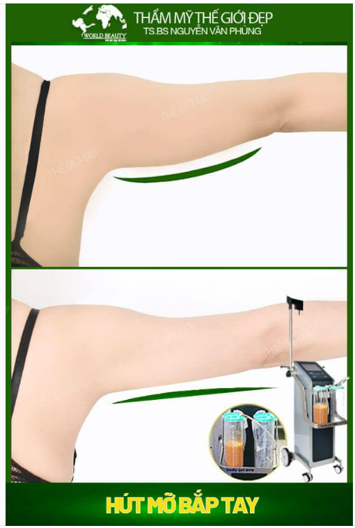 SỰ THẬT SAU HÚT MỠ BẮP TAY BẰNG CÔNG NGHỆ BODY - JET - EVO ĐƯỢC BẬT MÍ