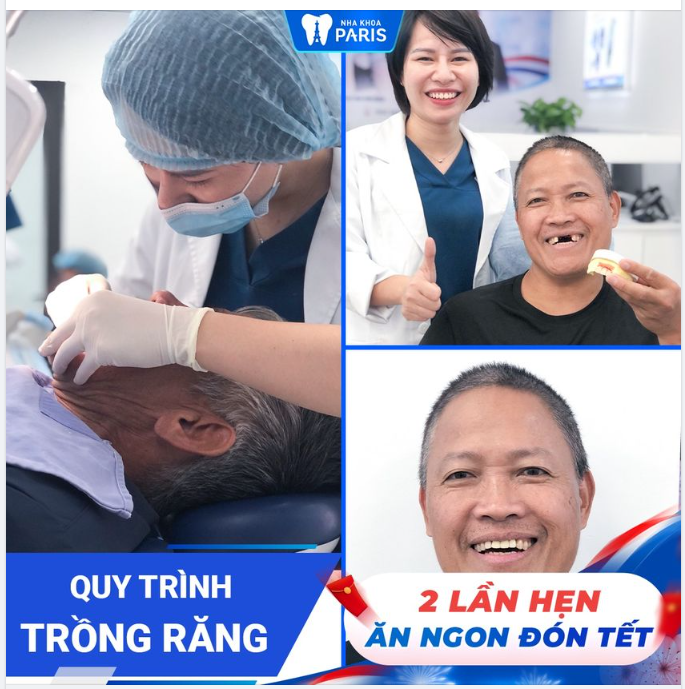 QUY TRÌNH TRỒNG RĂNG CHỈ 2 LẦN HẸN