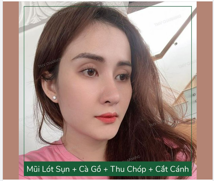 Nếu hạnh phúc được “gói” gọn trong hai chữ “trọn vẹn” thì em xin chọn “trọn gói”` mũi lót sụn, cắt cánh, cà gồ, thu chóp” để vẹn tròn nhan sắc, gói gọn niềm vui ạ