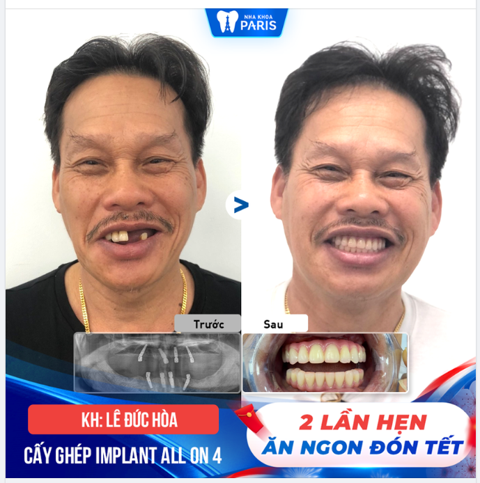 CẤY GHÉP IMPLANT ALL ON TOÀN HÀM ĂN NHAI BỀN CHẮC