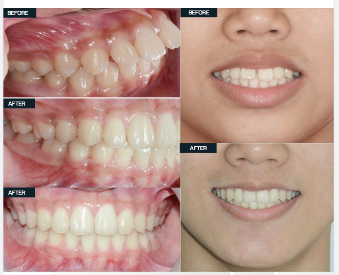 Ca lâm sàng chỉnh nha cho trường hợp khớp cắn hạng II