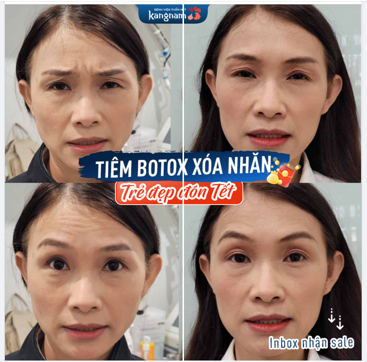Feedback Xóa nhăn bằng BOTOX với bác sĩ da liễu Kangnam