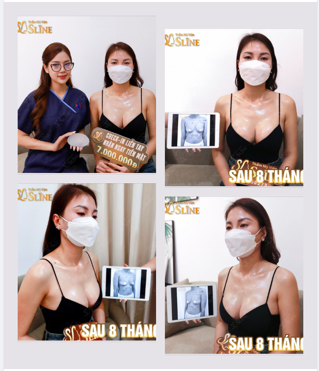 Giật mình với size túi ngực 335Cc  8 tháng tuổi lên form quá đẹp.