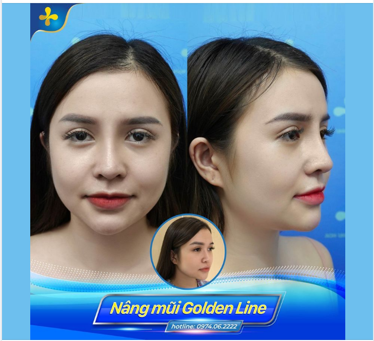 Mũi đã tiêm filler nhưng không đạt được kỳ vọng như mong muốn, bạn gái quyết định nâng mũi Golden Line - Dr.Tống Hải.